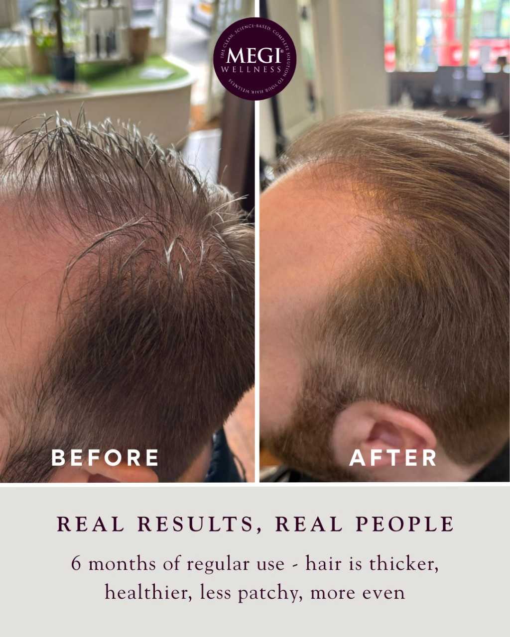 Side-by-side comparison of a mans scalp shows thinning hair BEFORE and fuller hair AFTER 6 months of regular use with Megi® Wellness Growth Stimulating Hair Serum, promoting thicker, healthier, more even hair.